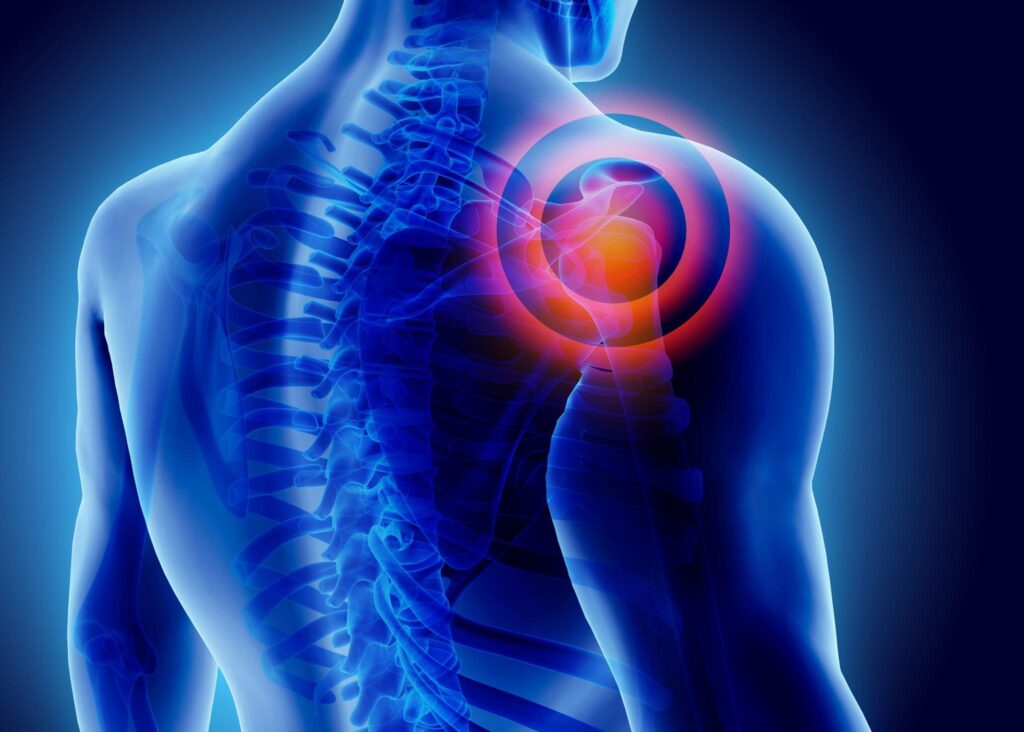 Shoulder Replacement