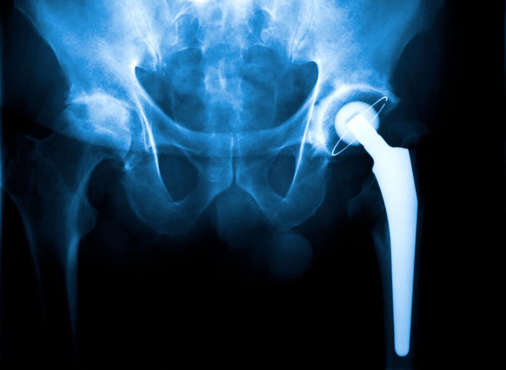 Hip Replacemnt