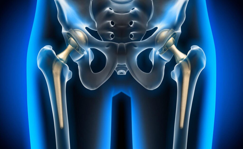 Hip Replacement